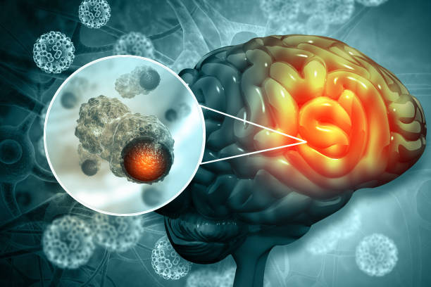 causes of brain tumor causes of brain tumor