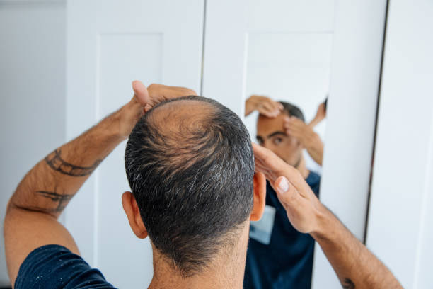 How Lifestyle Decisions and Stress Affect Hair Loss Over Time hair loss
